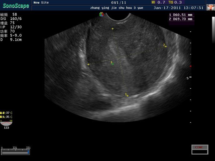 子宫肌瘤超声消融治疗效果图(三) 
