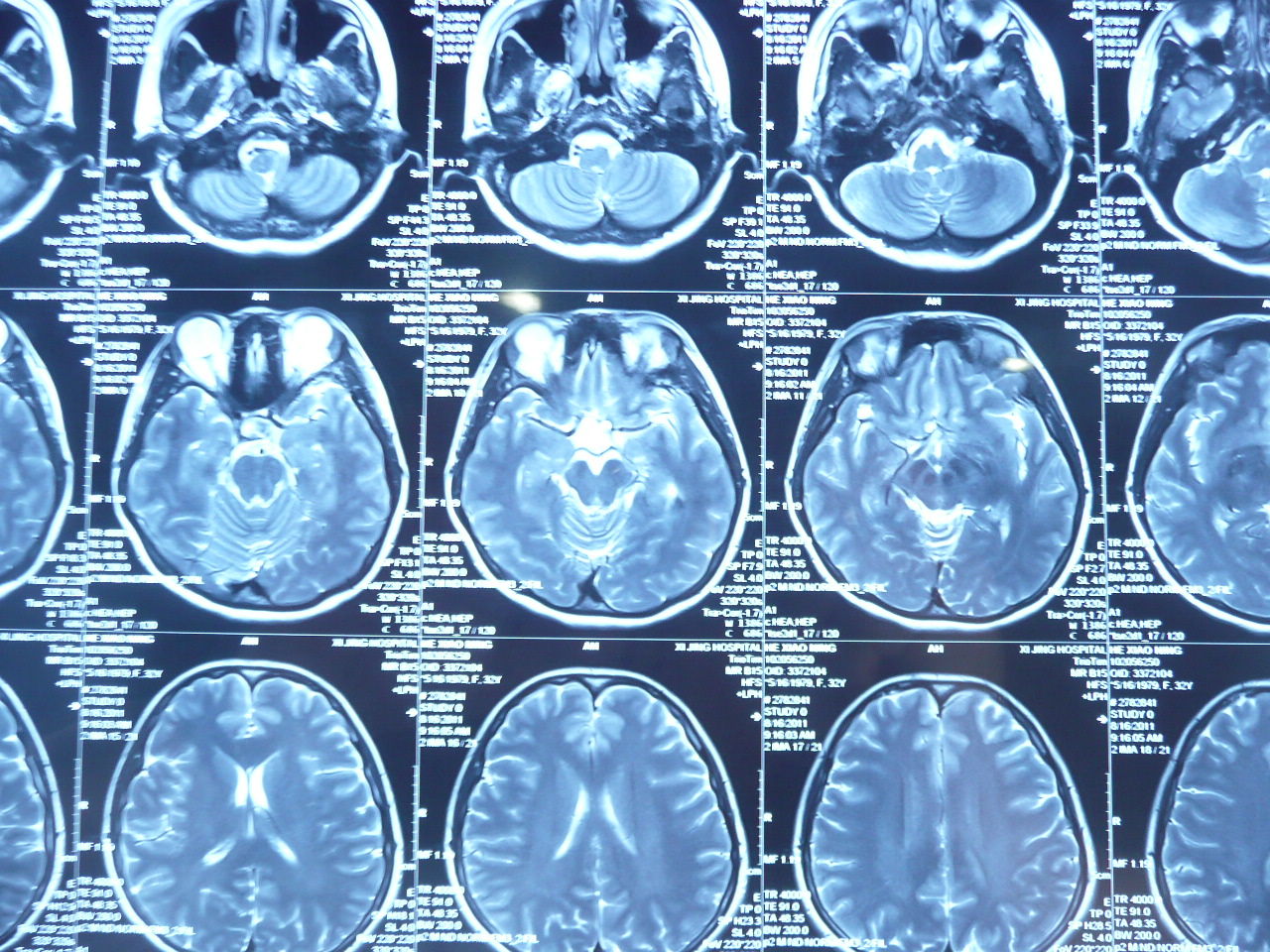 颅内鞍区囊肿的手术治疗(图组) - 好大夫在线