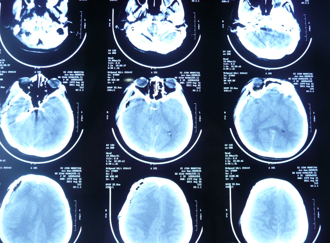 鞍区囊肿的手术治疗实例多图