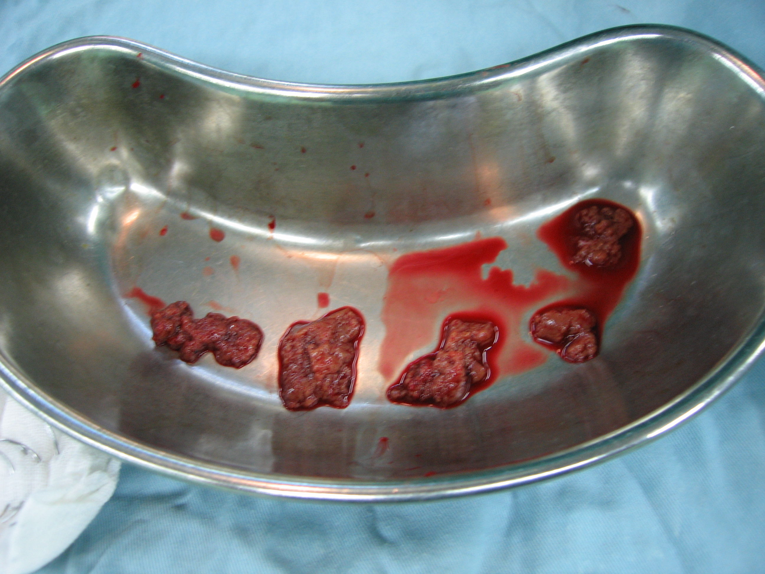 多个抢救小组快速完成输液,输血,麻醉和手术图一:右半身严重挫伤,肝区