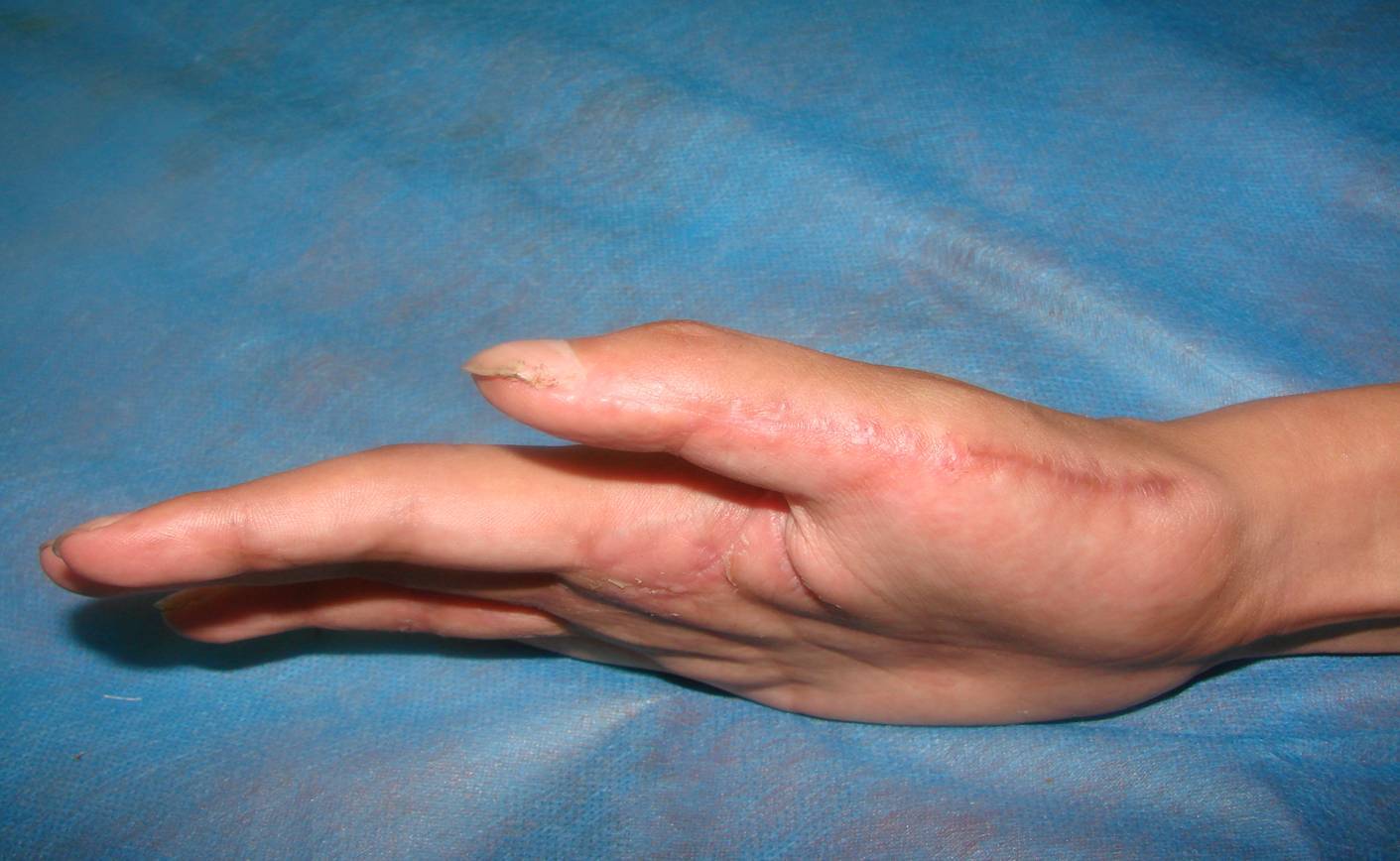 拇指桡背侧皮瓣修复拇指诊断皮肤缺损