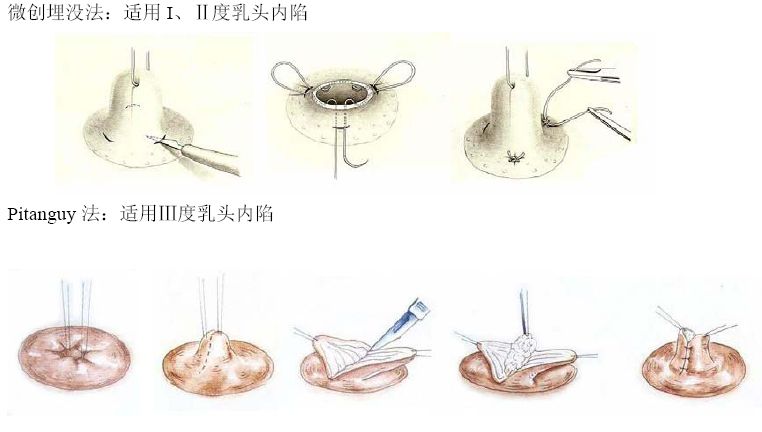 乳头内陷牵引术图片