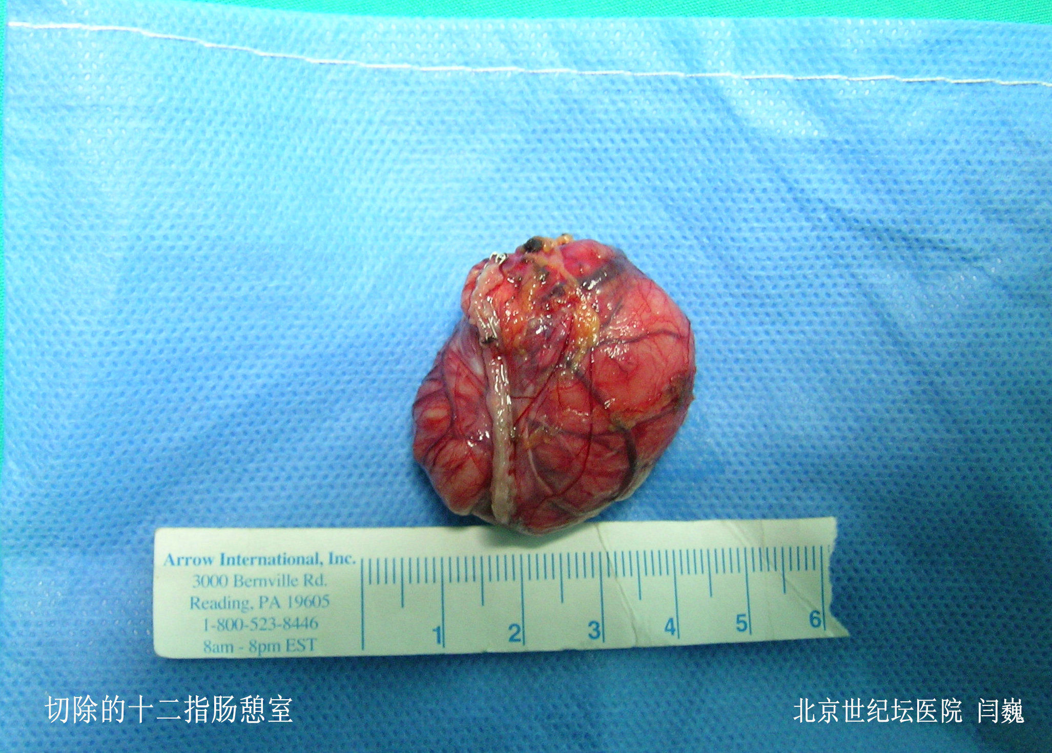 4,空腸造瘻術作為附加手術在患者術後恢復中起到了非常重要的作用