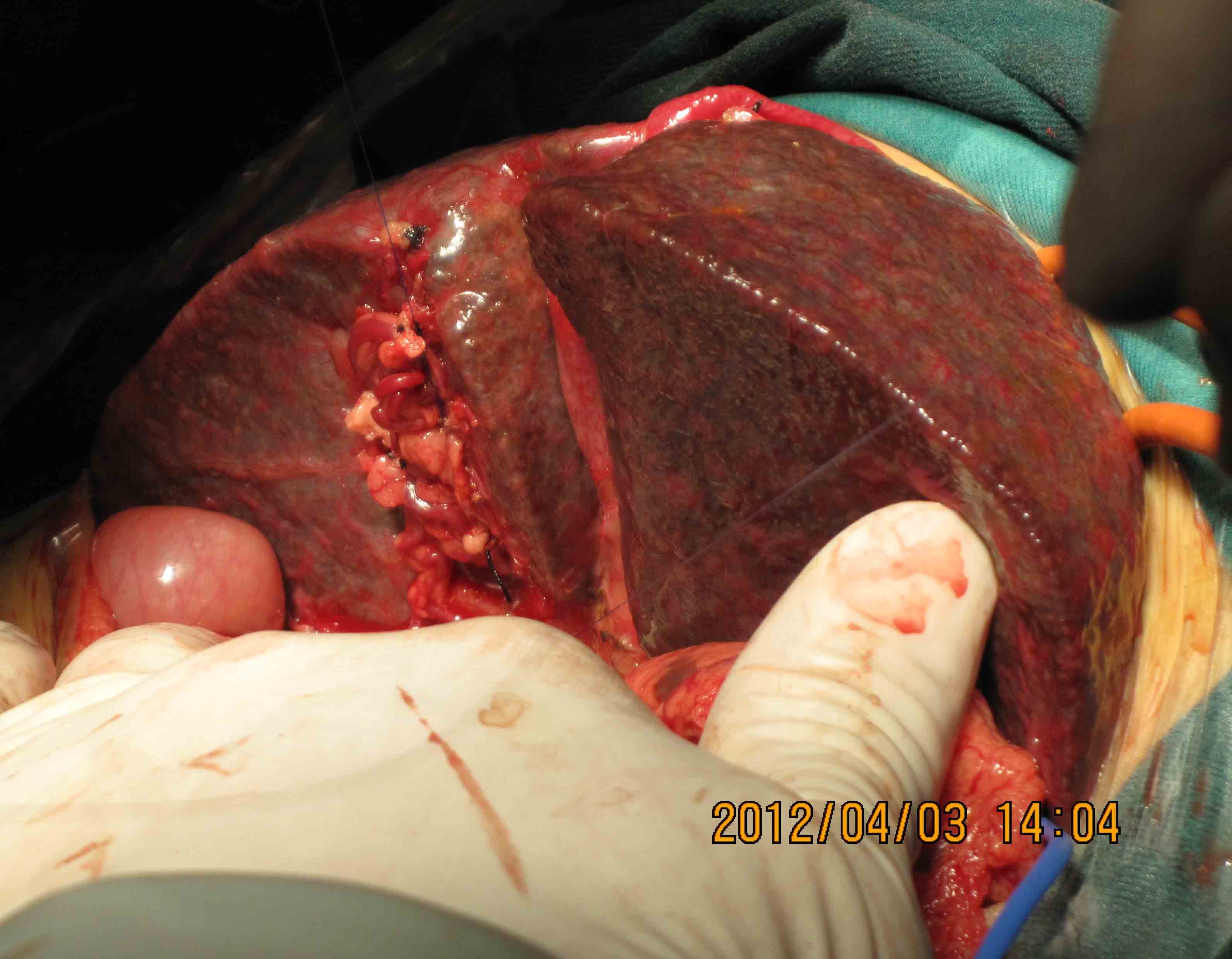做肝移植后伤口图片图片