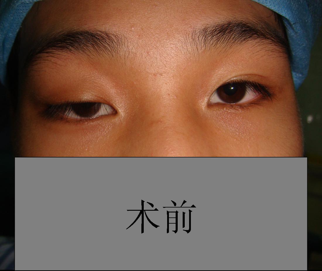 图片病例1—上睑下垂—单侧先天性上睑下垂(提上睑肌缩短) - 好大夫