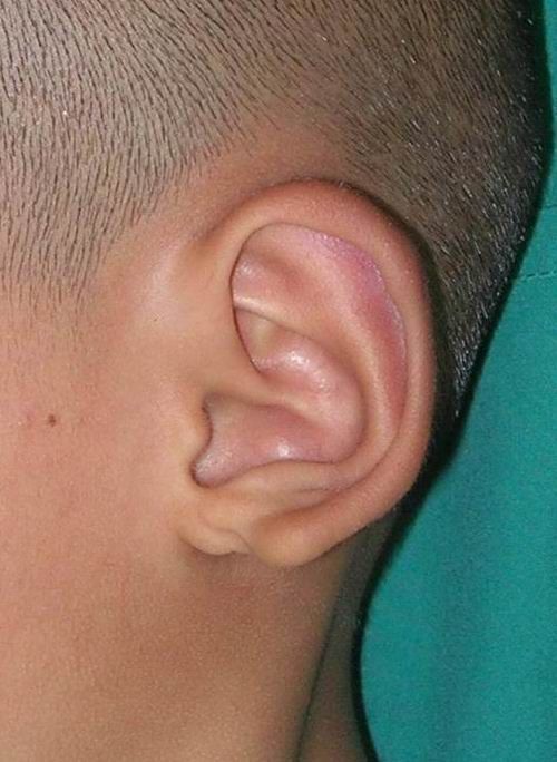 耳垂分裂畸形