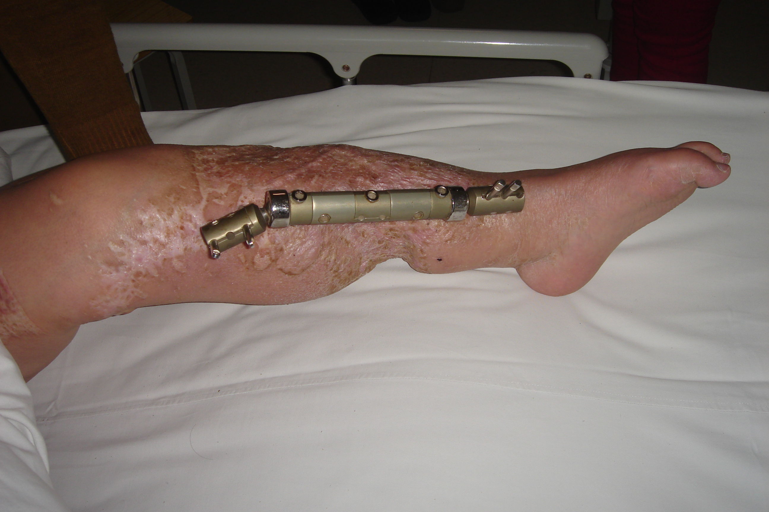 3年了 长段骨缺损 - 好大夫在线