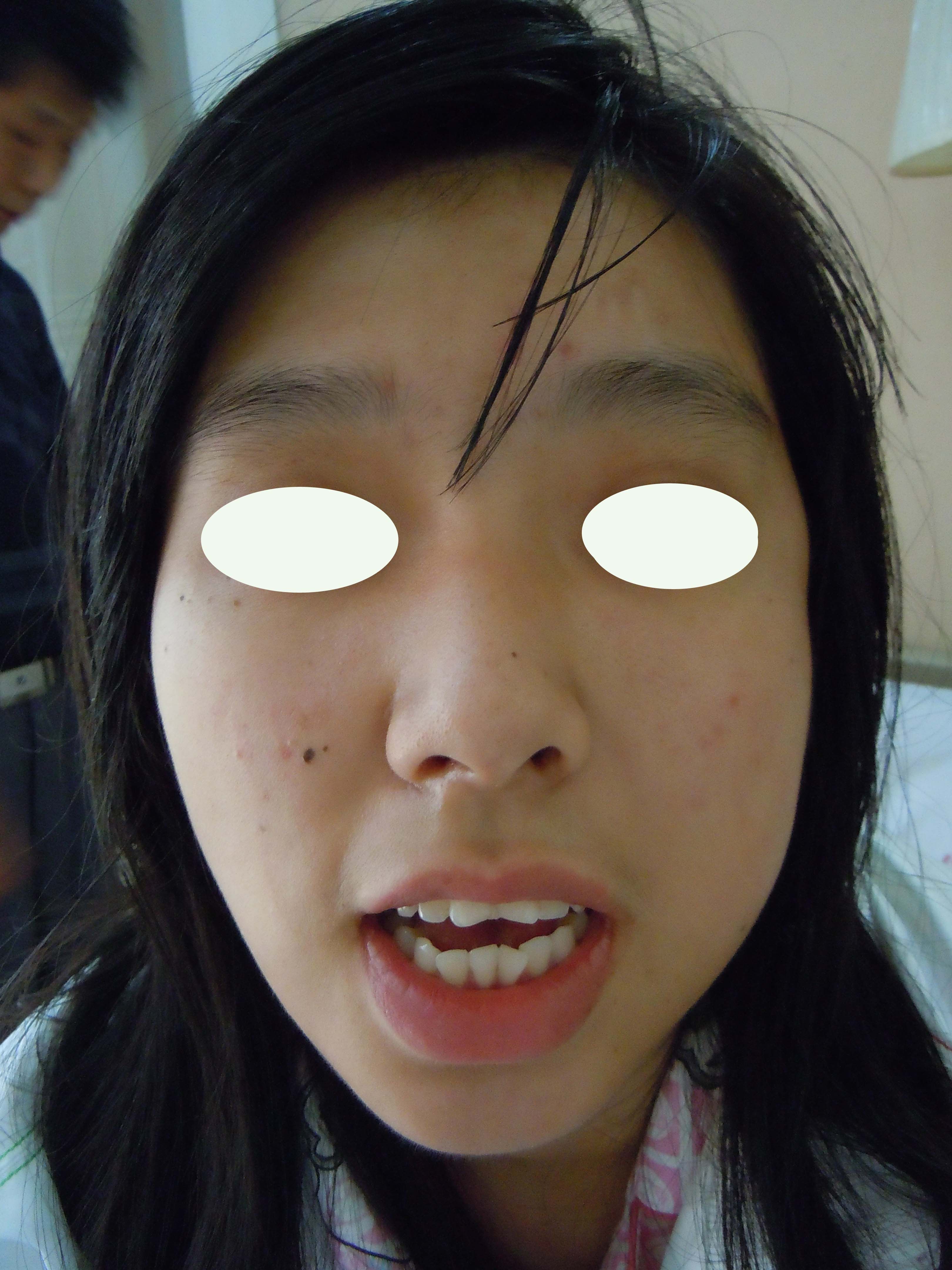 髁突高位切除术结合正畸治疗髁突肥大 - 好大夫在线