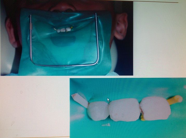 橡皮障技术----给儿童看牙带来安全和舒适 - 好大夫在线