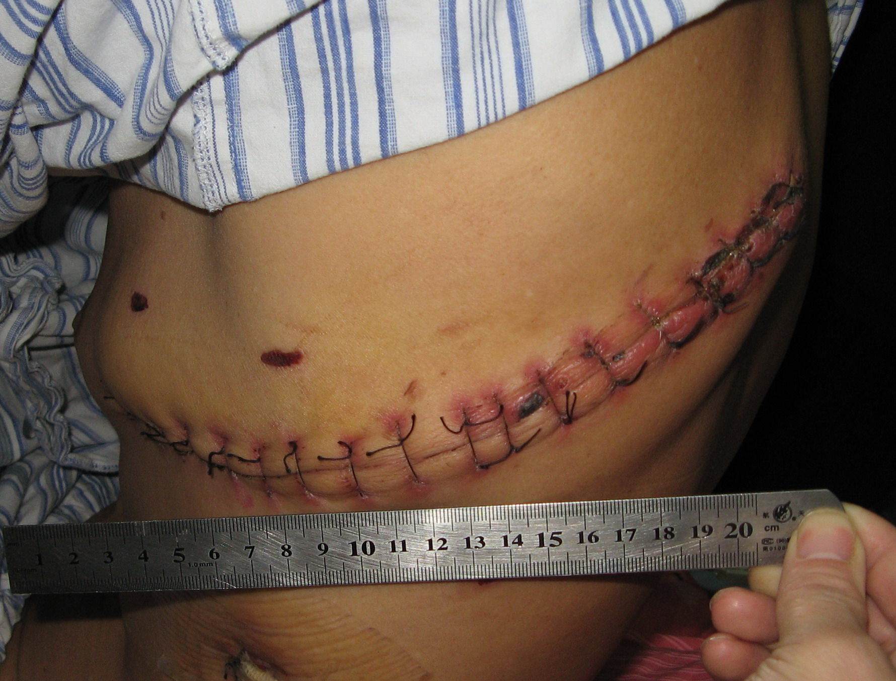 微创手术治疗包裹性胸腔积液,慢性包裹性脓胸 - 好大夫在线