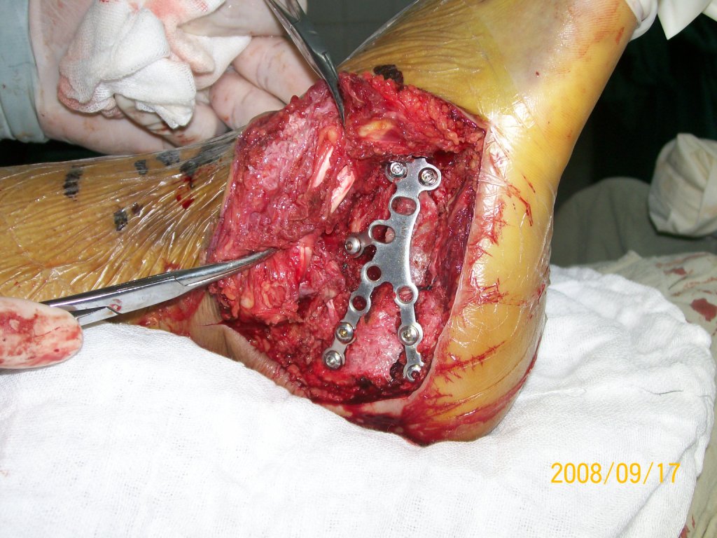 跟骨骨折内固定术 - 好大夫在线