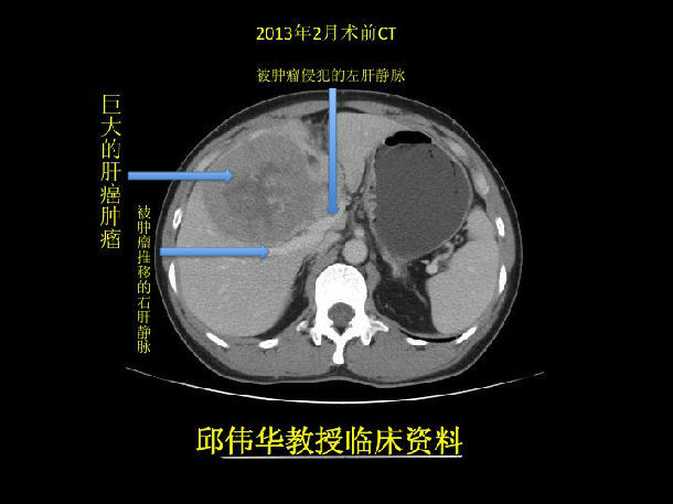 考慮到巨大的癌腫已經侵及大血管腫瘤分期已屬c期,根據衛生部頒佈的