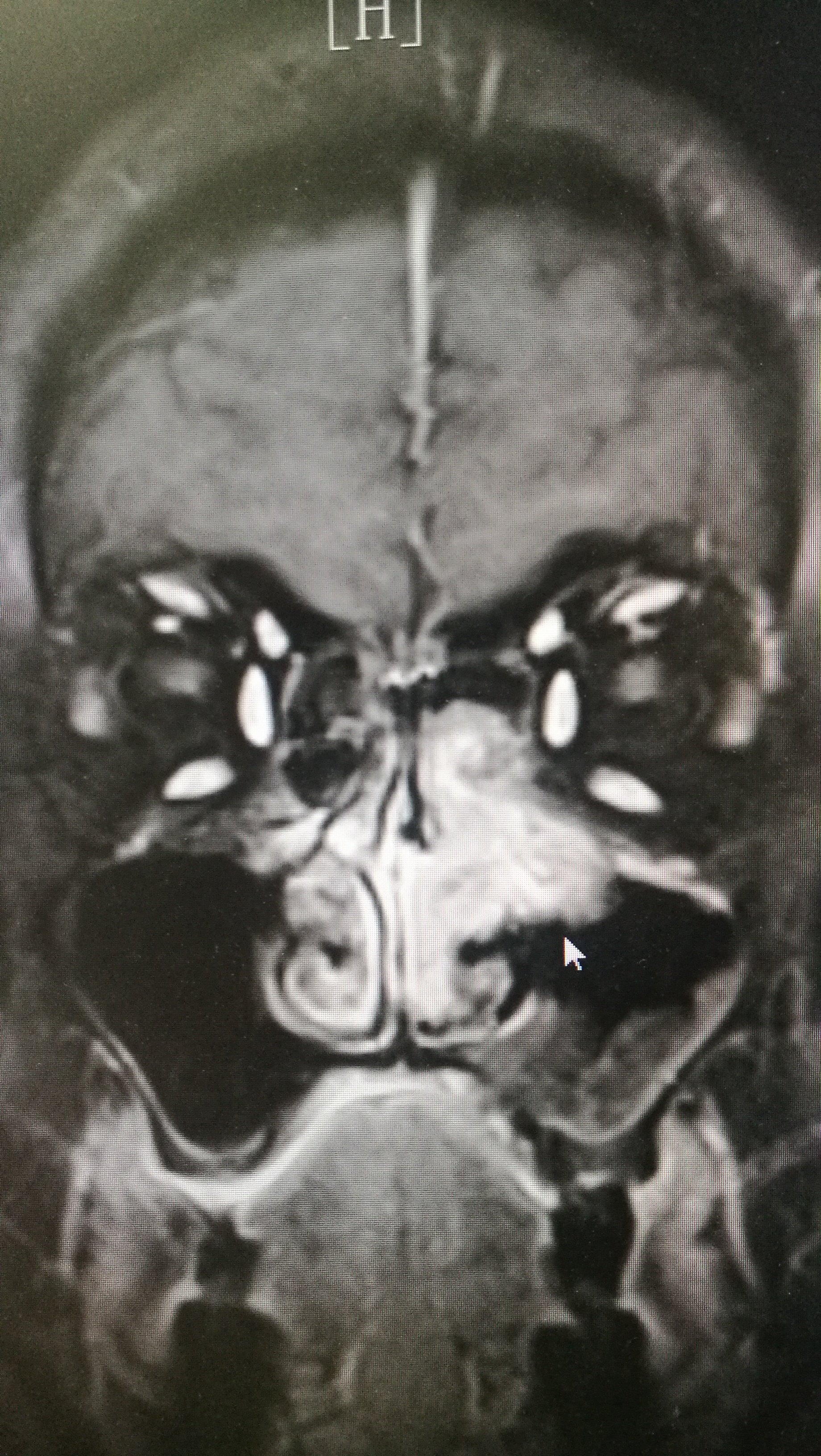 鼻中隔肿瘤图片图片