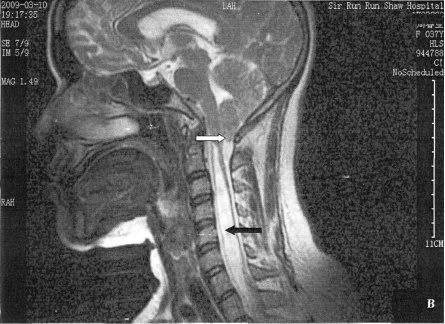 小脑扁桃体下疝ct图片图片