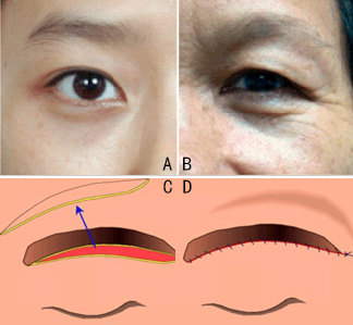 眼部衰老,眼皮松弛,三角眼了怎么办? 