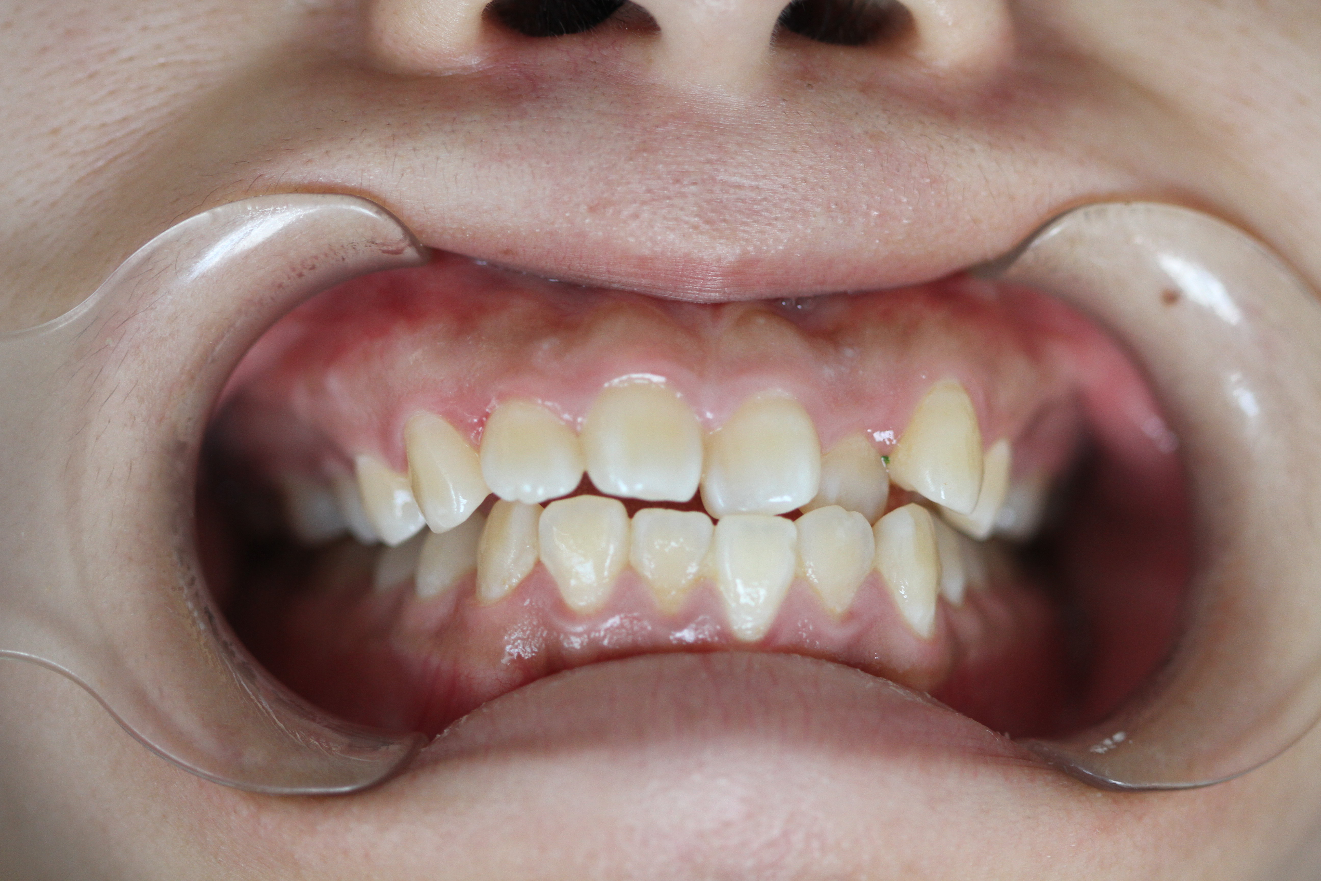 警惕个别牙反合 - 好大夫在线