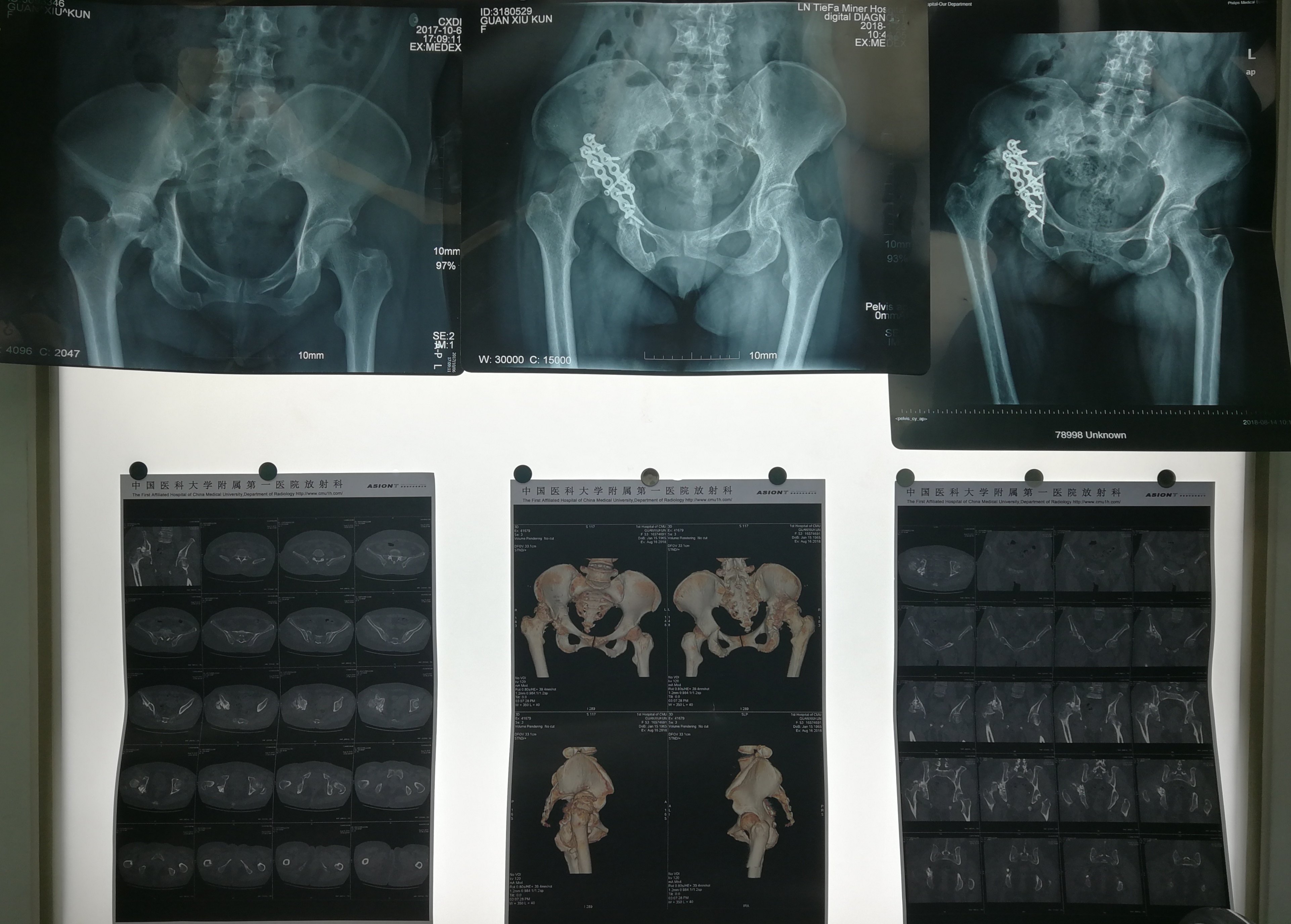 53歲女性髖臼骨折術後一年疼痛人工全髖關節置換術