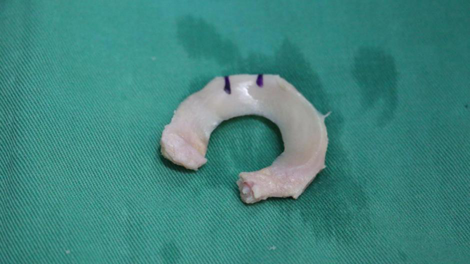 半月板移植并不像传统的器官移植那样需要严格的组织配型,而且 术