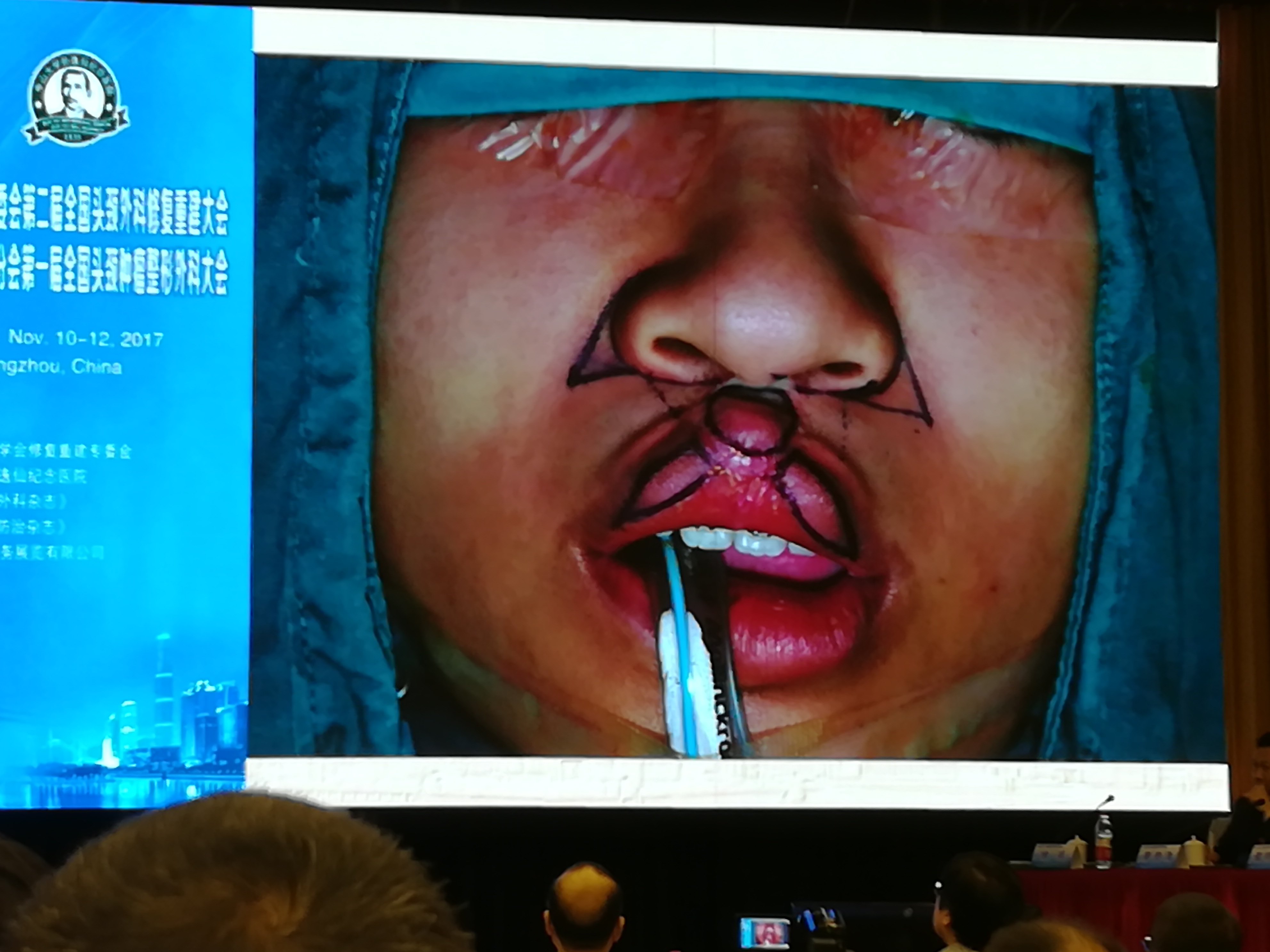 唇裂的手术治疗 - 好大夫在线