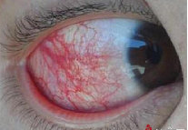 白化病虹膜图片图片