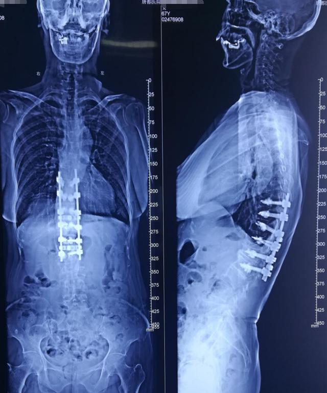 脊柱后凸病人图片