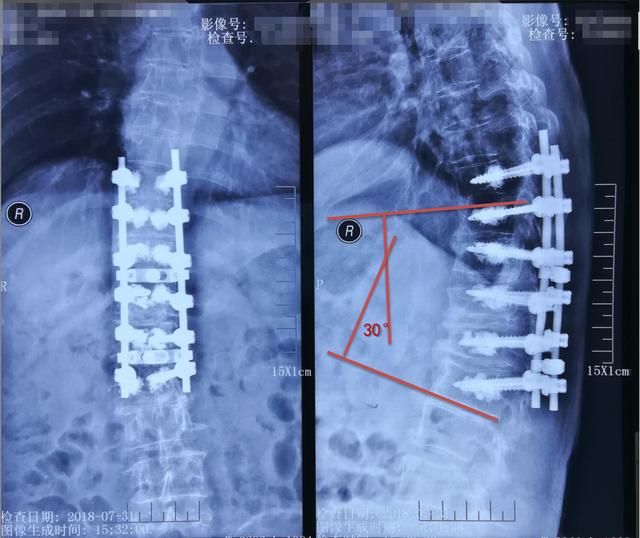 病例分享:胸腰段脊柱后凸畸形 