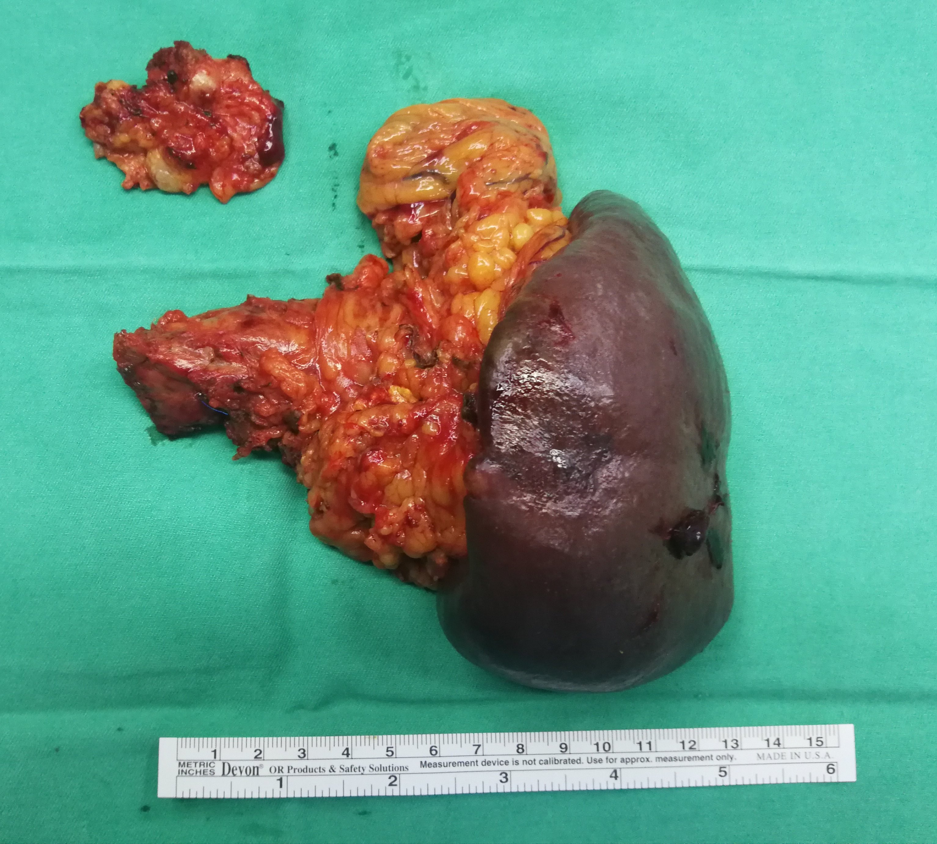 胰尾癌晚期图片