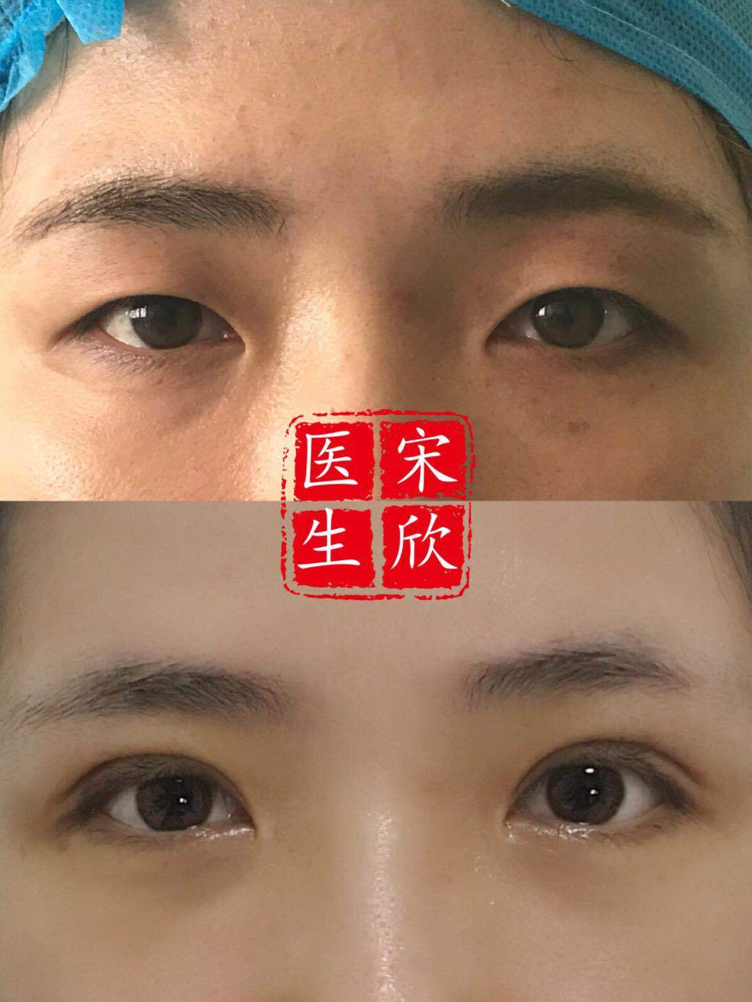 上海九院双眼皮术前术后案例分析(3) - 好大夫在线
