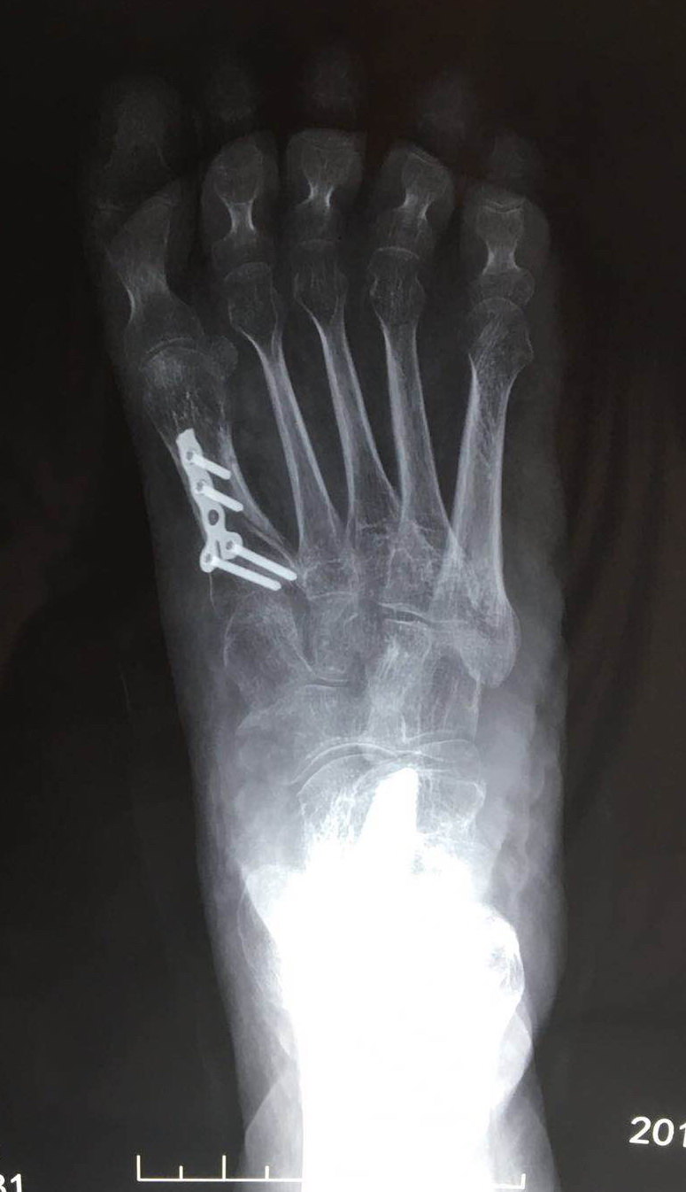 第一跖骨cotton截骨纠正跖屈畸形跟骨倾斜角和merry角纠正正常.