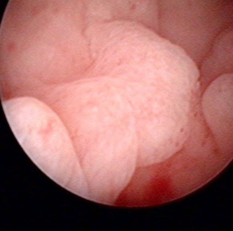 大片子宫内膜息肉图片图片