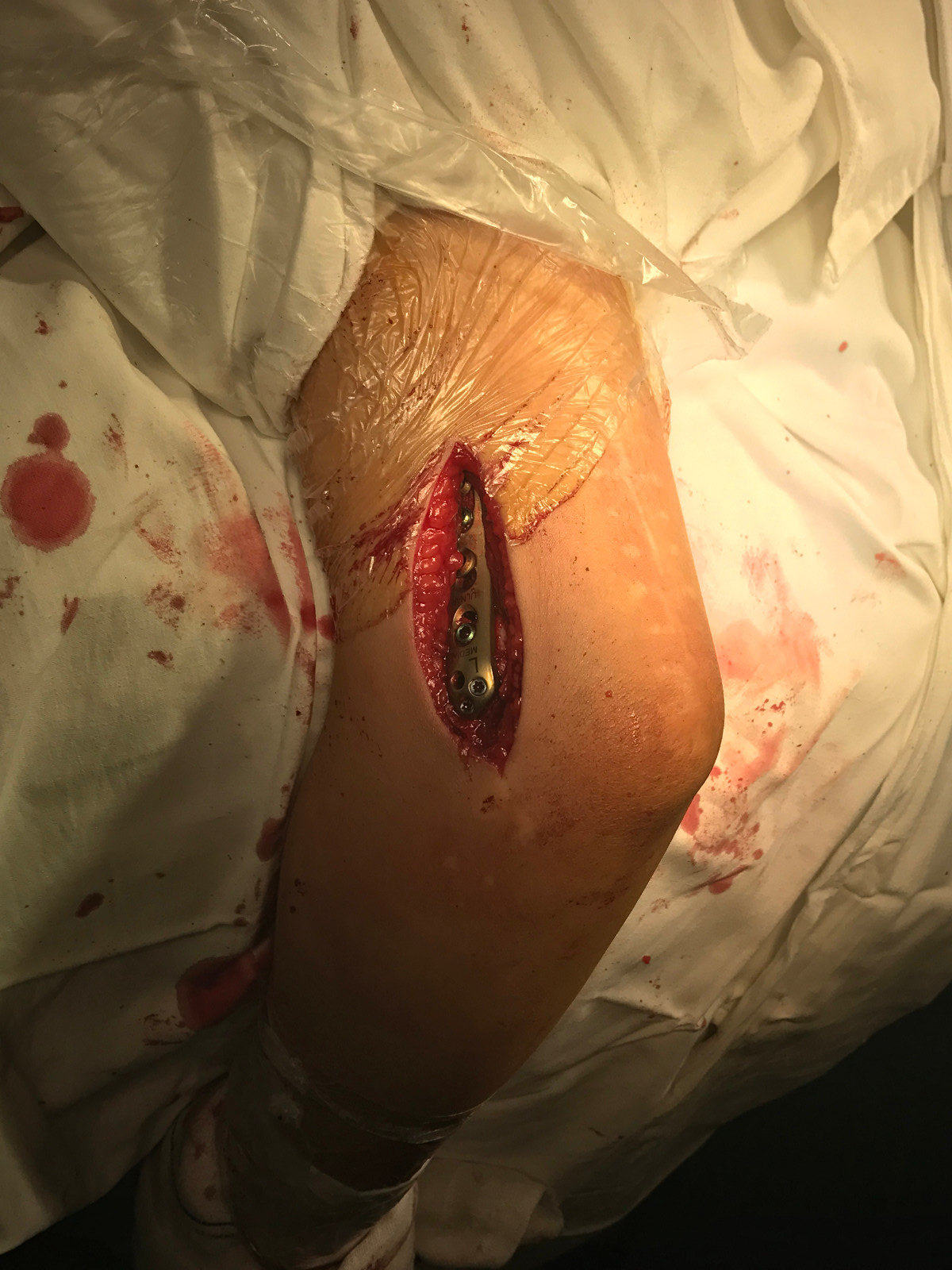 肘内翻畸形矫正术前术后及随访,您满意吗? - 好大夫在线