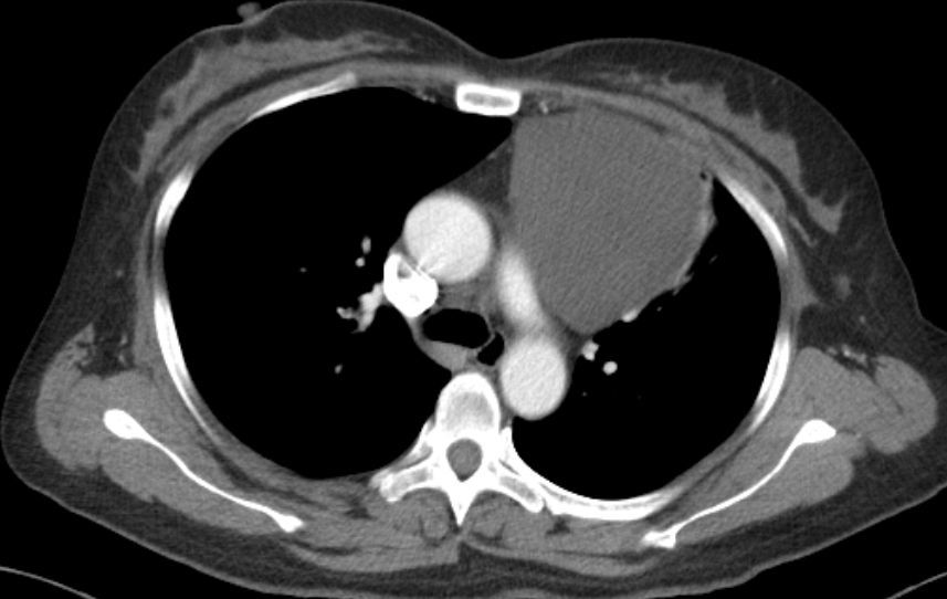 胸腺囊腫與胸腺瘤區別是什麼需要手術嗎thymiccyst