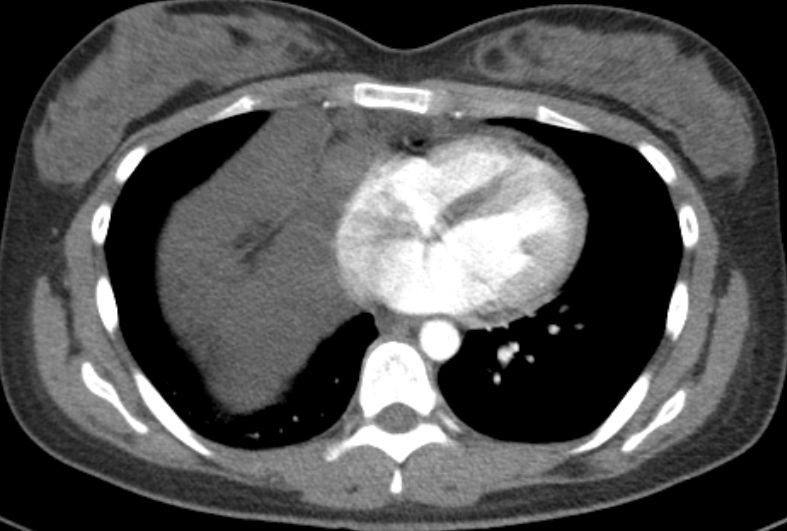 胸腺囊腫與胸腺瘤區別是什麼需要手術嗎thymiccyst