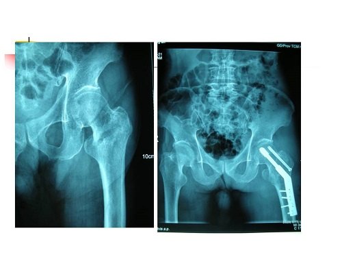 股骨颈骨折临床表现及治疗