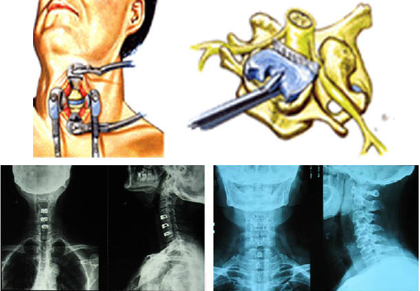手术是怎么治好颈椎病的 颈椎病 手术