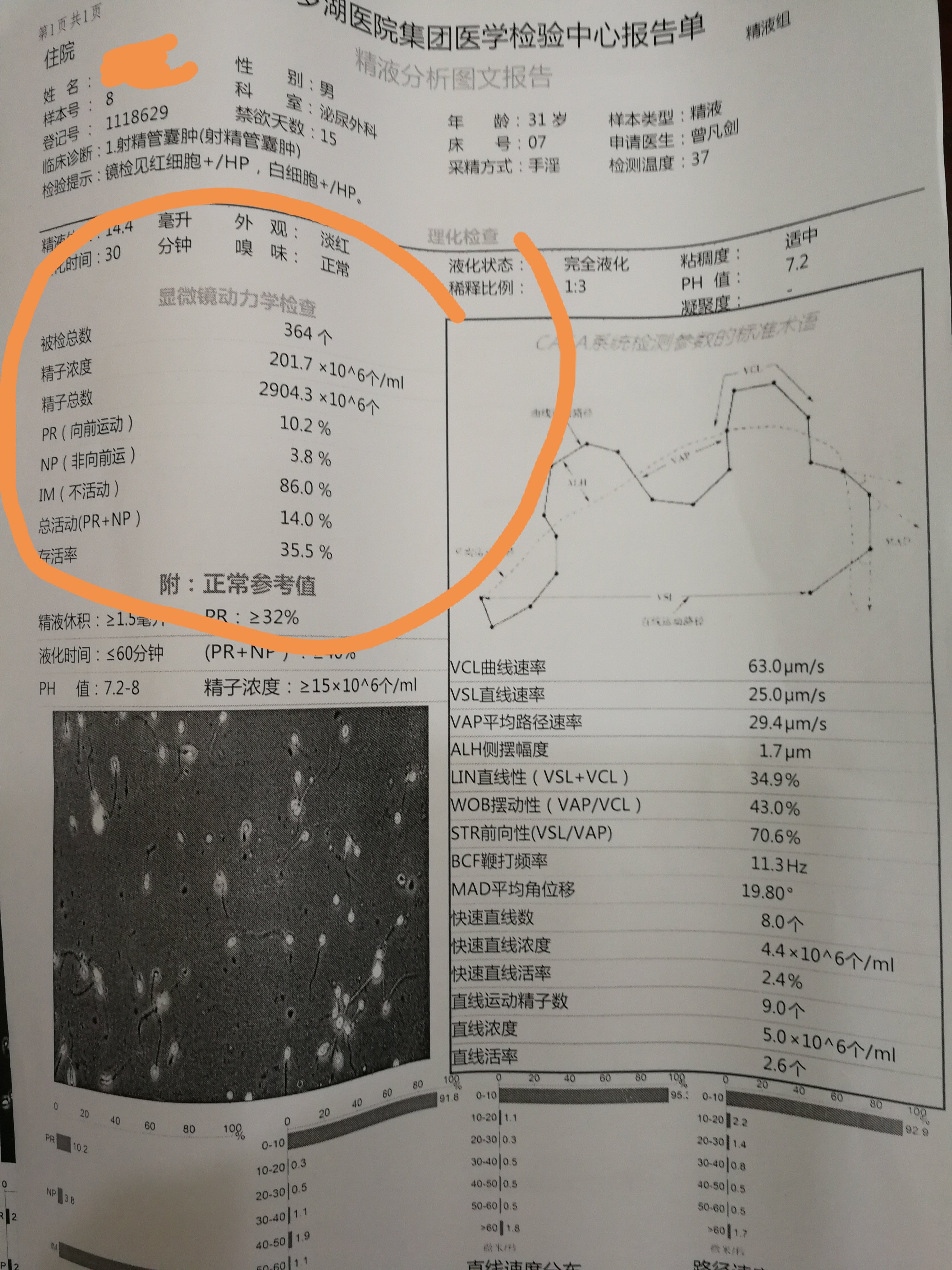 射精管梗阻,经自然通道精囊镜治疗二天后