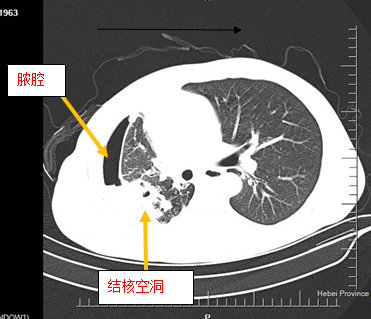 结核性支气管胸膜瘘——困扰患者多年的顽疾终于被治好了 - 好大夫