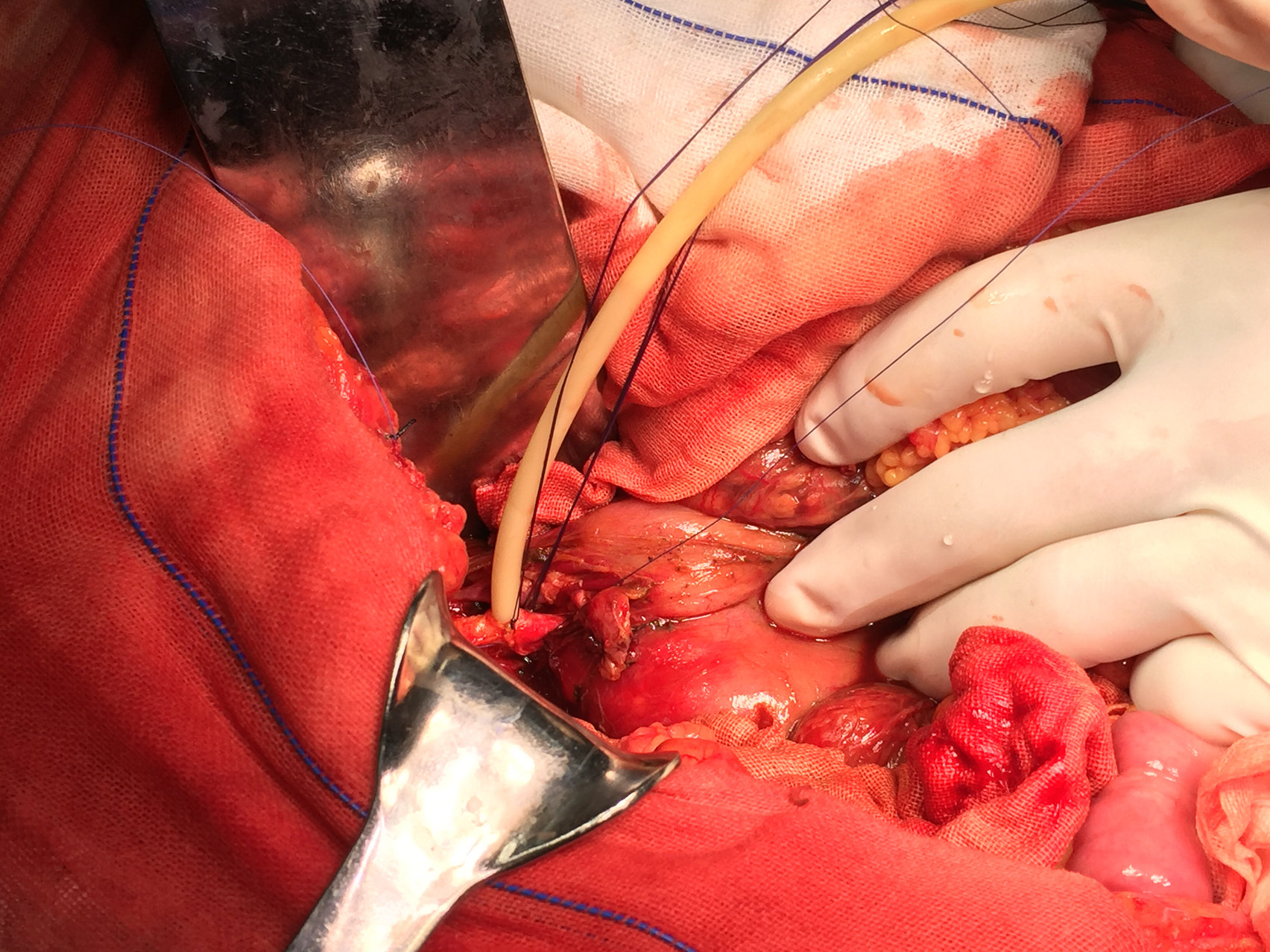 前几天腹部外伤肝破裂腹膜后血肿胆总管横断 - 好大夫在线