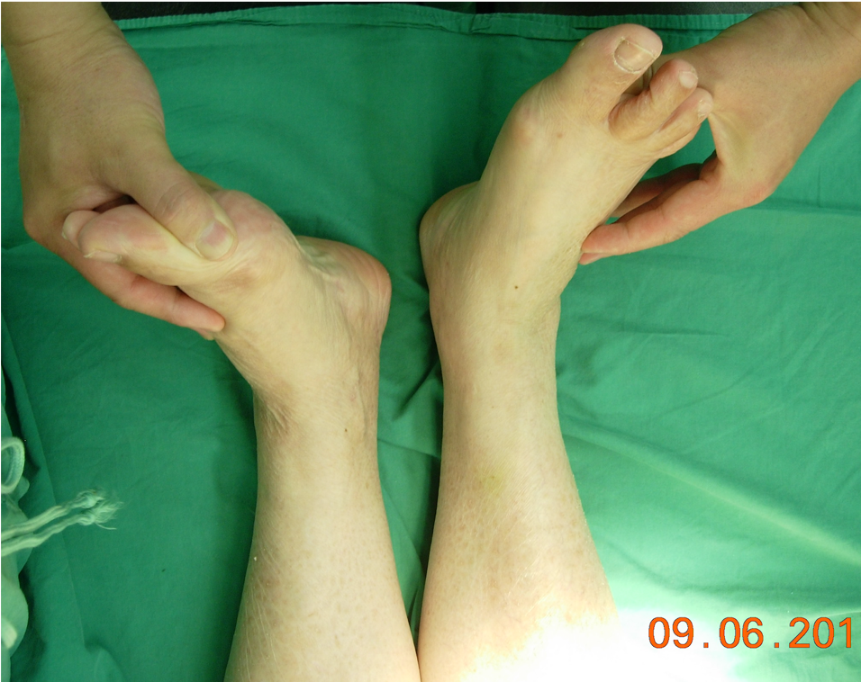 图6:股骨头坏死晚期,出现双下肢不等长预防:1