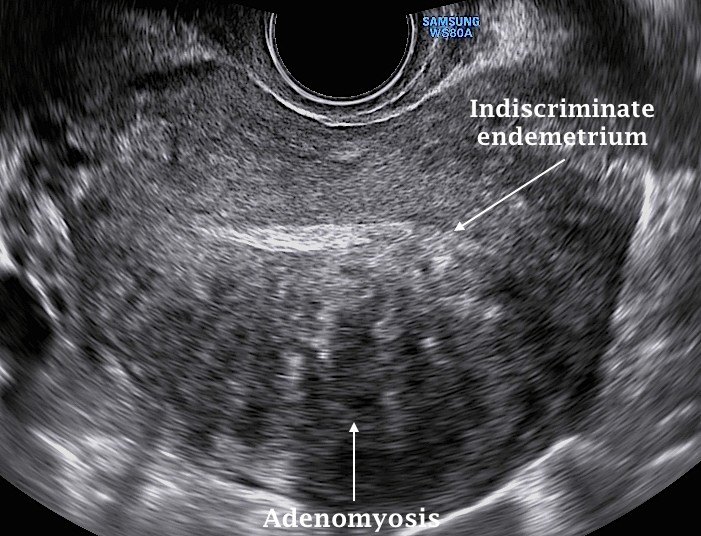 子宫腺肌症彩超图片