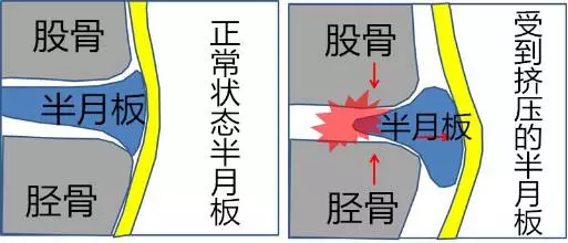 大力踢球踢空,蹲下行走,跑步中被絆倒時容易產生半月板損傷; 2,慢性退