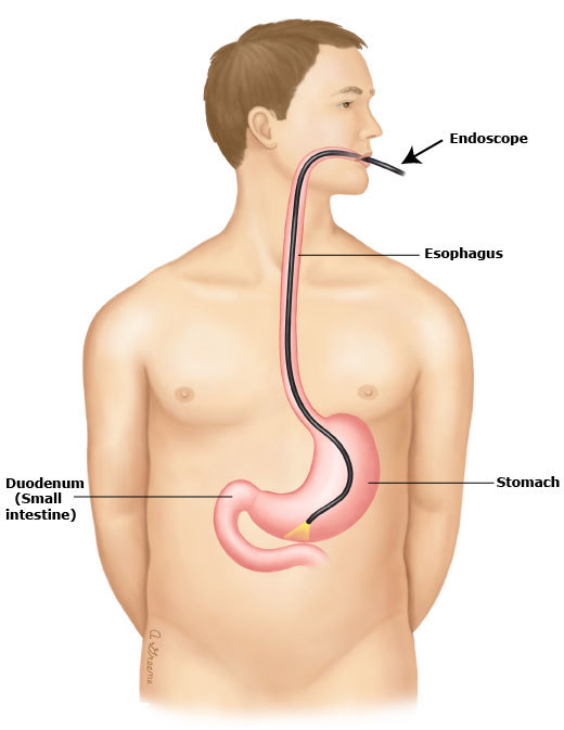 Upper-endoscopy-PI.jpeg