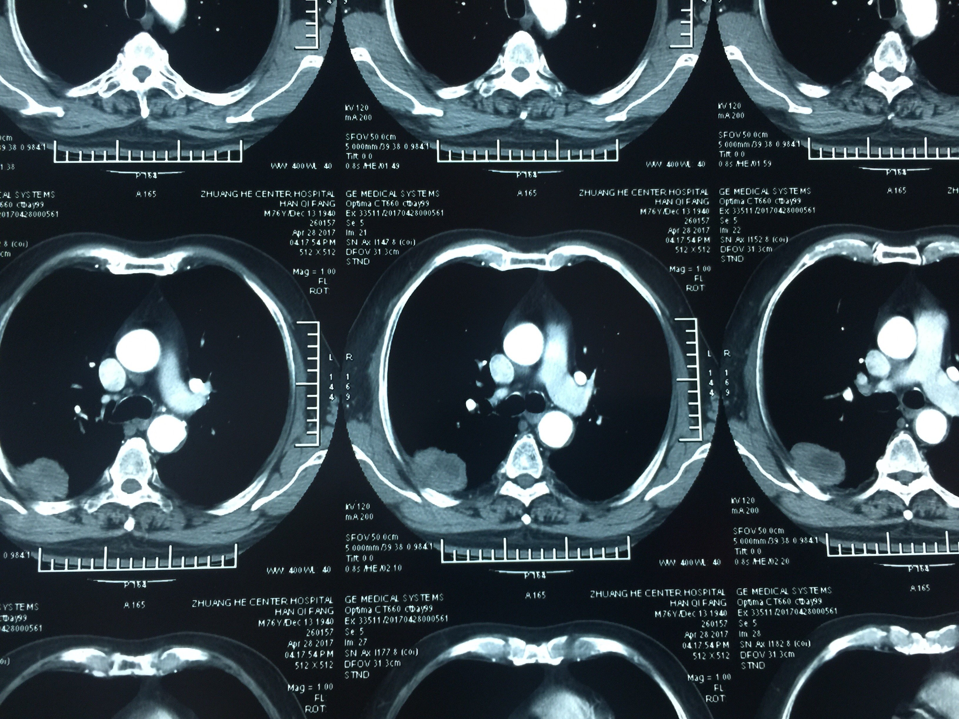 术前肺部ct提示病变已经侵犯肋骨,患者伴有骨痛