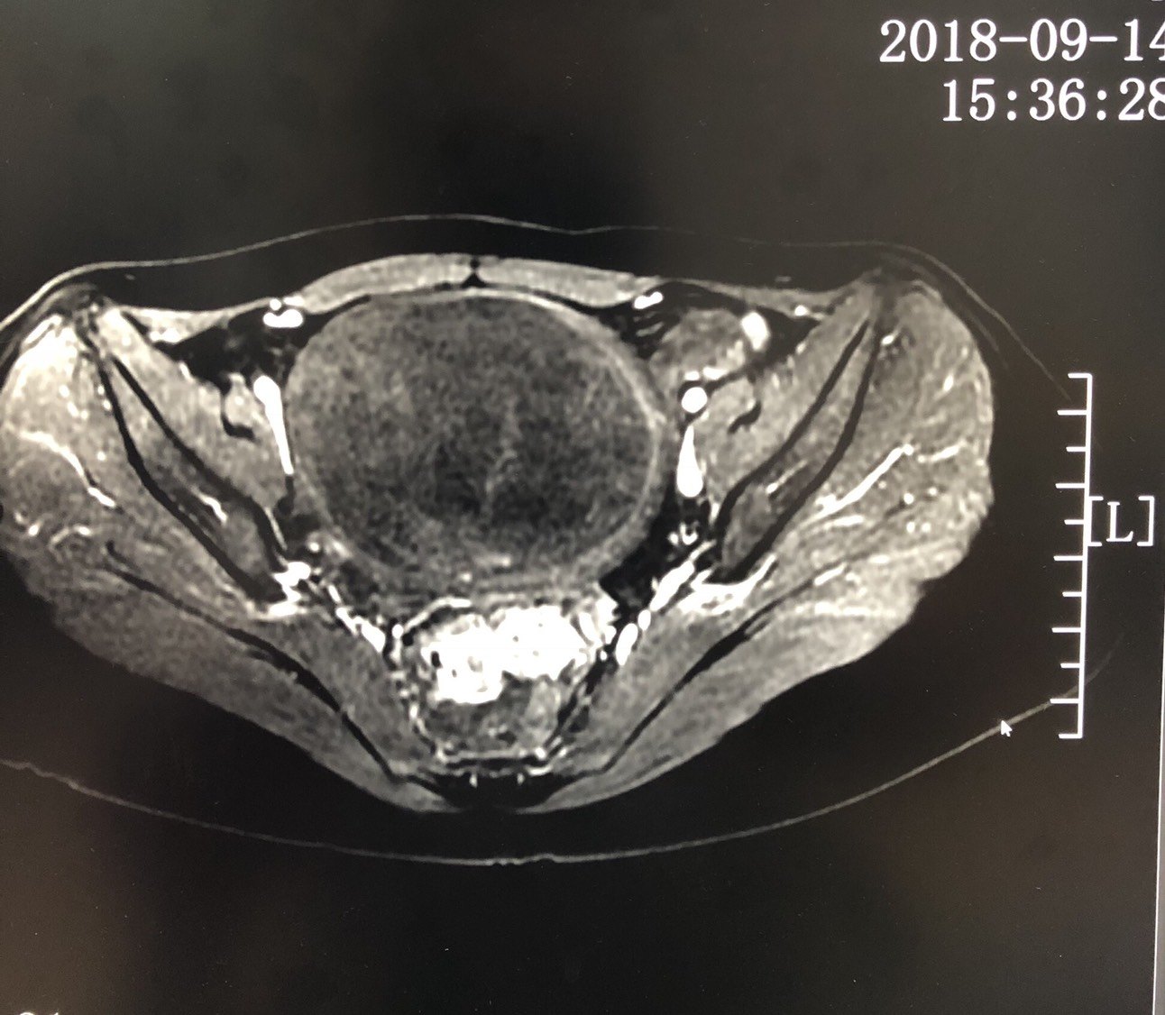 11×8厘米子宫变性大肌瘤磁波刀手术成功! - 好大夫在线