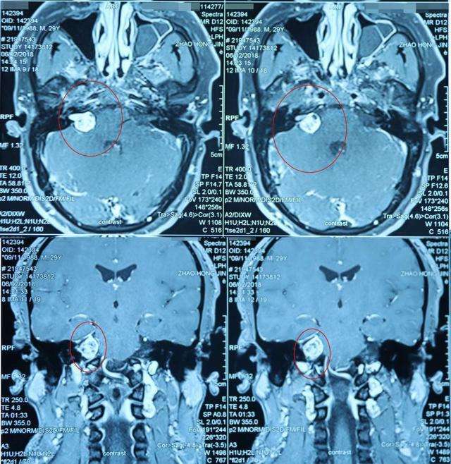 听神经瘤位置图图片