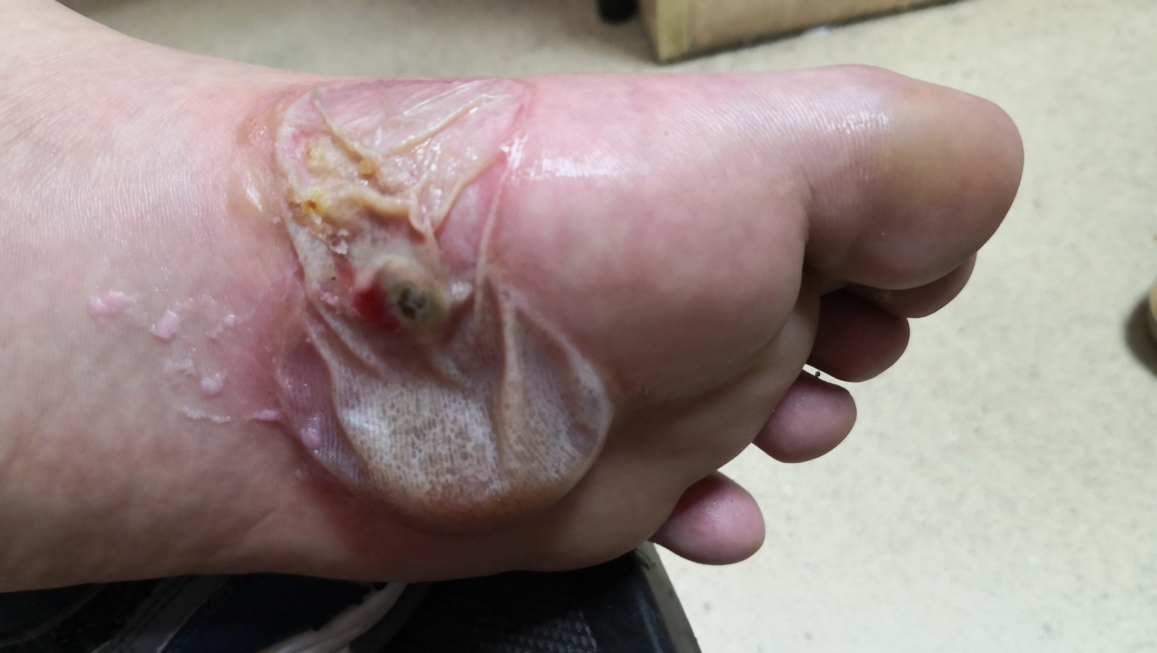 大蒜引起的接触性皮炎_接触性皮炎