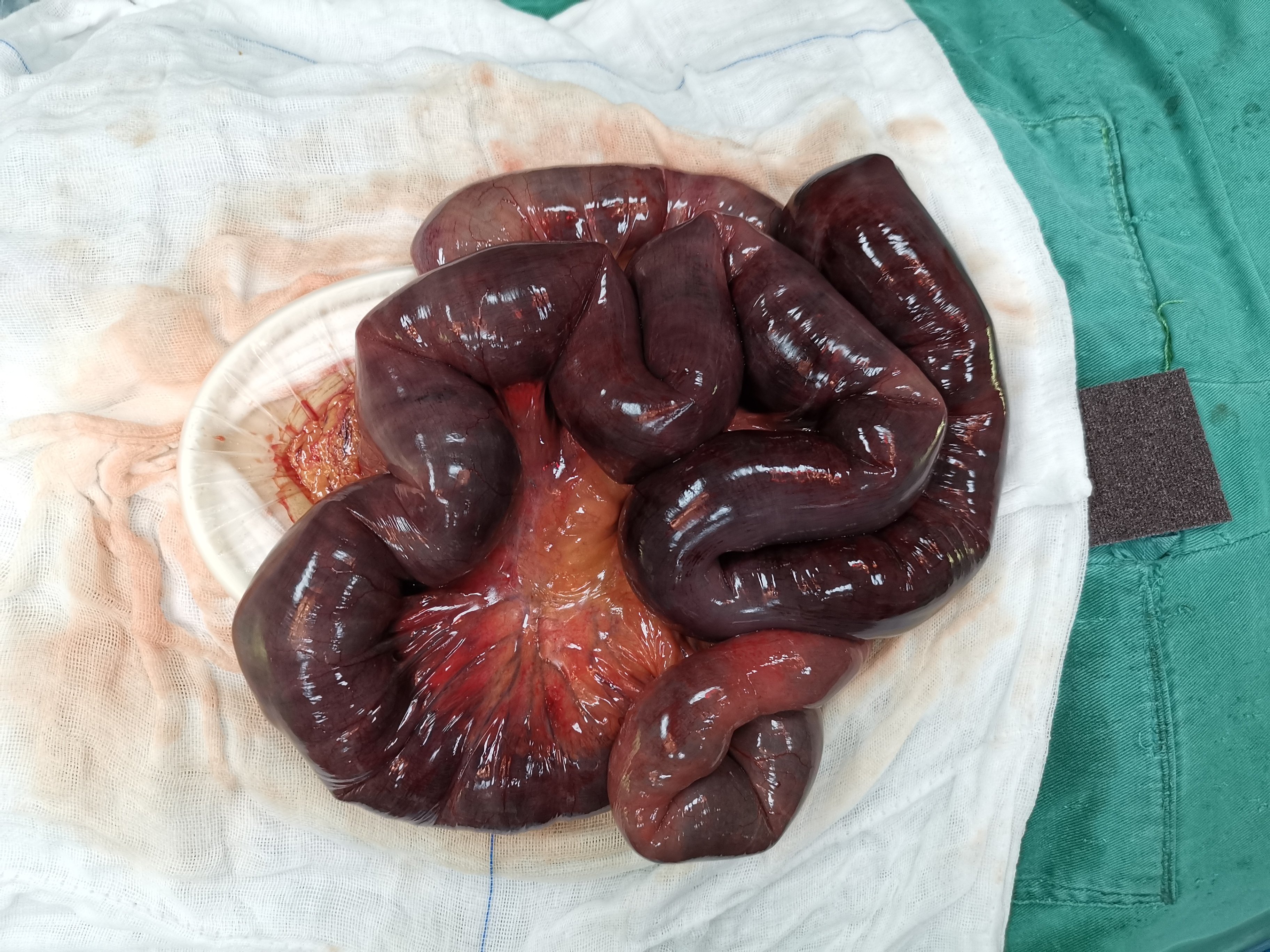 肠系膜血管破裂图片