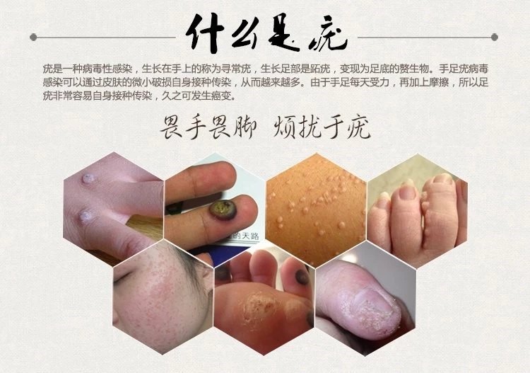 皮肤疣的类型 疣