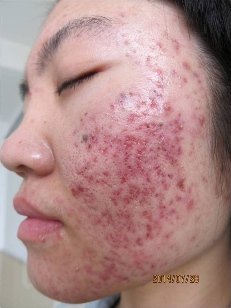 病例分享:痤疮_痤疮_痤疮治疗方式 - 好大夫在线