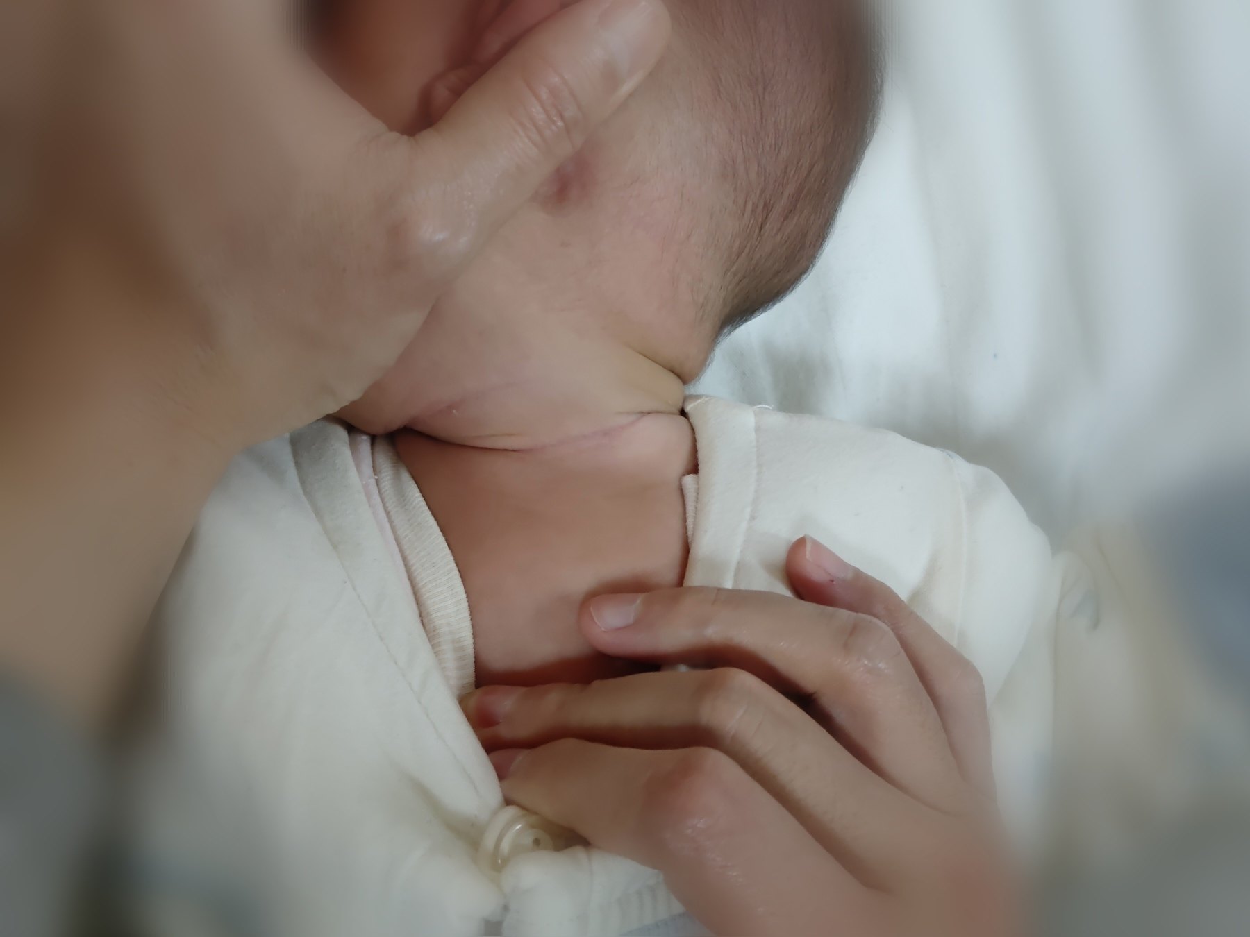 婴儿斜颈的症状表现图片